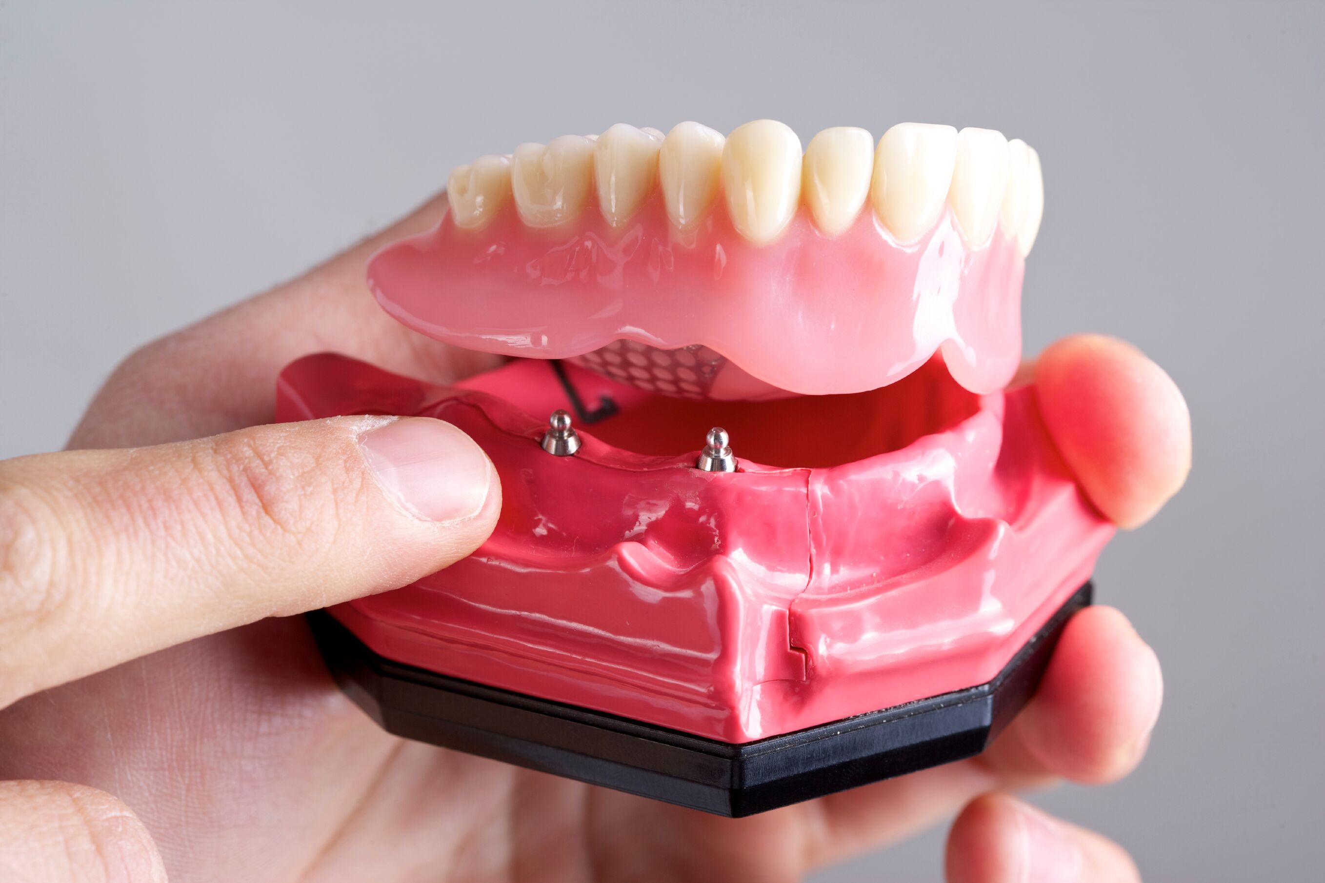 Permanent Dentures Implant Retained Dentures Dr Rick Cofer